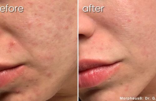 Before and after comparison of morpheus acne scar treatment