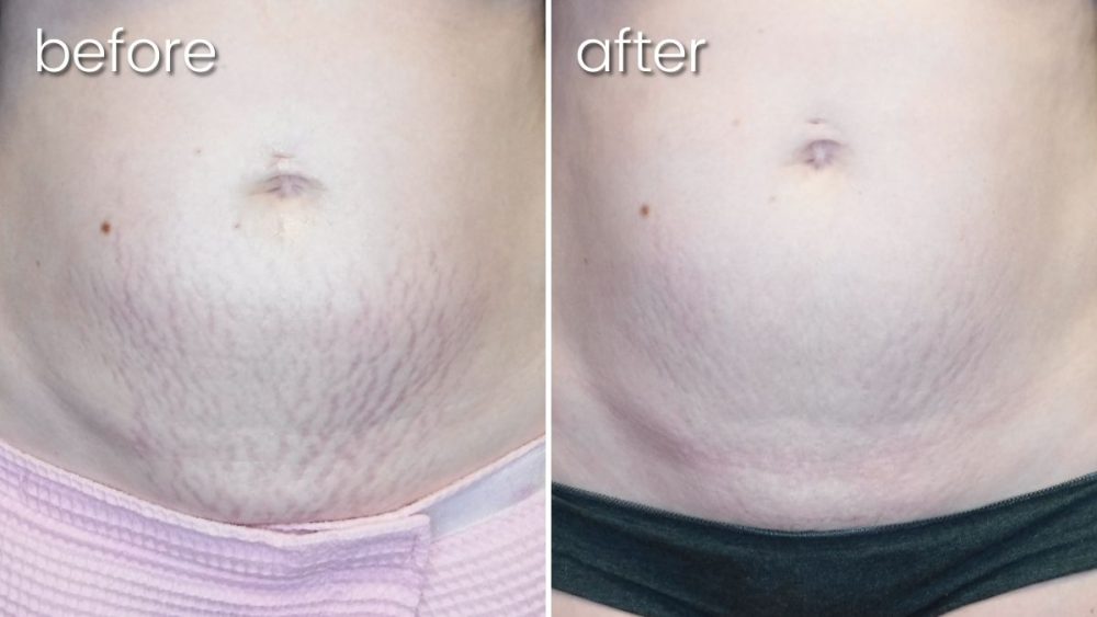 Before and after stomach stretch marks comparison