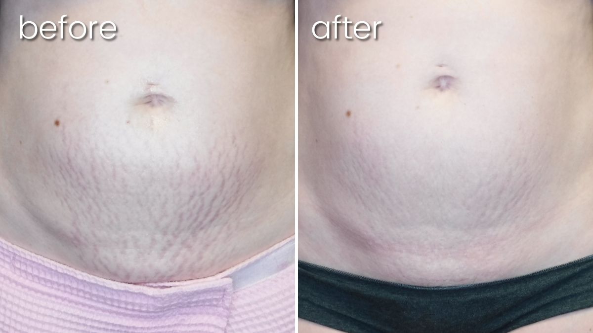 RF Microneedling for Stretch Marks? How Does it Work? - Smooth Synergy  Medical Spa & Laser Center
