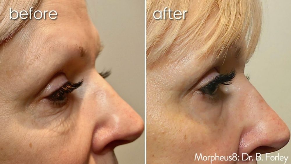 Before & After Morpheus 8 Treatment Around Woman's Eyes | Skin Treatment - Bakersfield CA