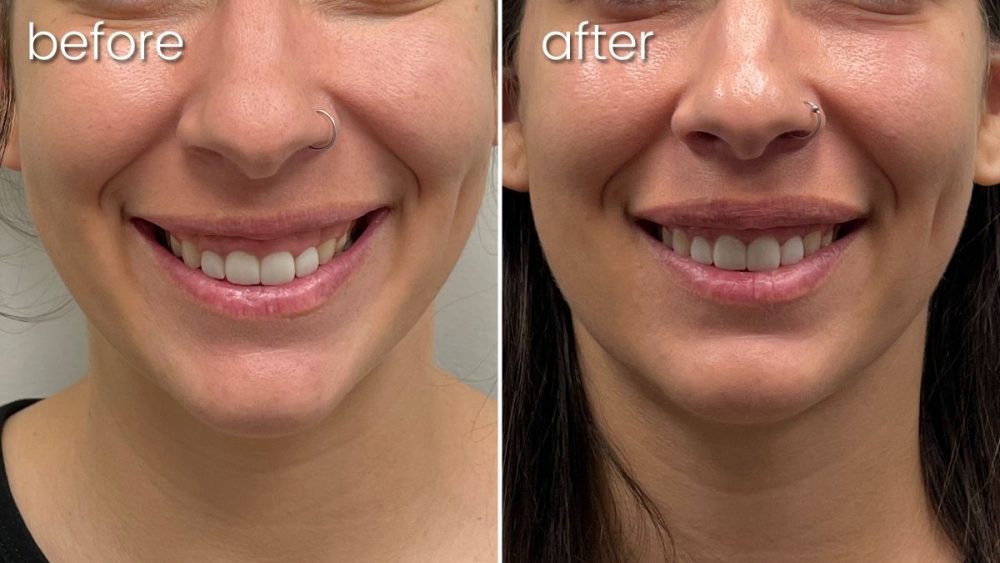 Before and After - Neurotoxin for a Woman's Gummy Smile | Lip Fillers - Bakersfield CA