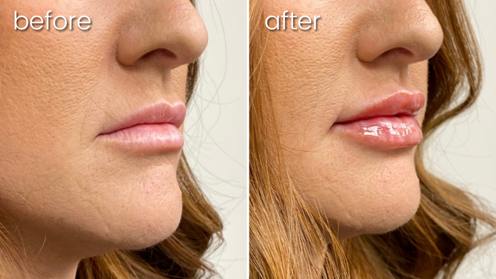 a before and after photo of a woman 's lips from a dermal filler service