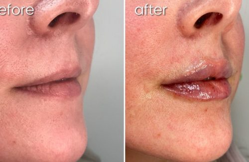 a before and after lip filler photo of a woman 's lips