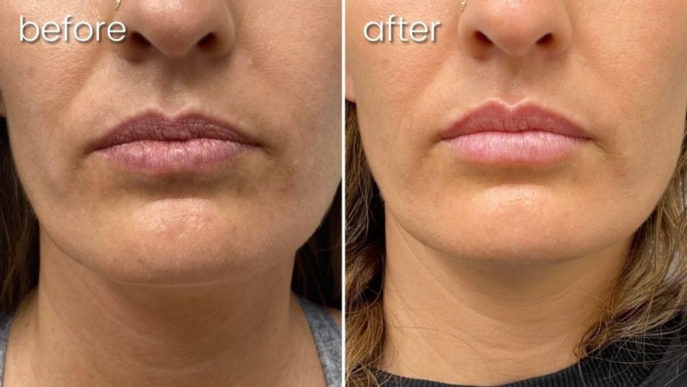 Before & After Dermal Lip Filler on Woman | Lip Fillers - Bakersfield CA