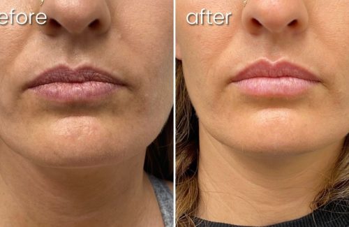 Before & After Dermal Lip Filler on Woman | Lip Fillers - Bakersfield CA