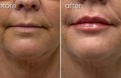 Before & After Dermal Lip Filler on Elderly Woman | Lip Fillers - Bakersfield CA