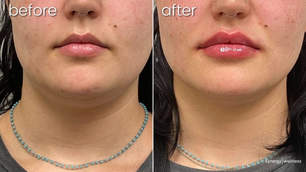 Before & After Lip Fillers on Young Woman | Dermal Fillers for Lips - Bakersfield CA