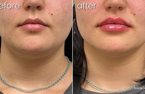 Before & After Lip Fillers on Young Woman | Dermal Fillers for Lips - Bakersfield CA