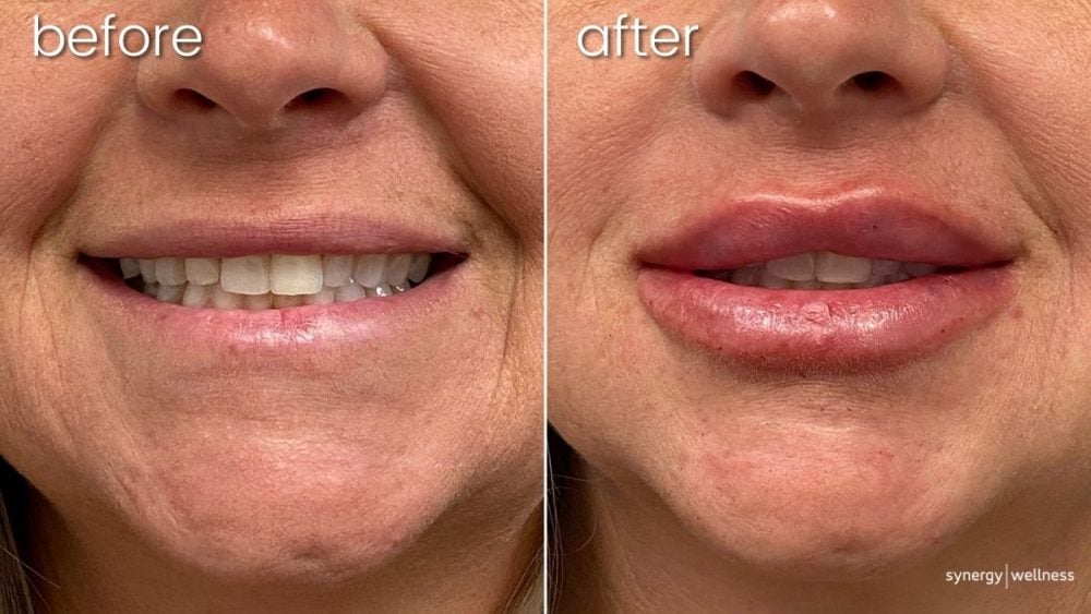 Before & After Lip FIllers on Middle-Aged Woman | Lip FIllers - Bakersfield CA