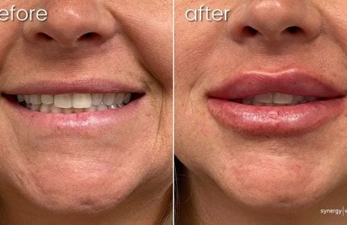 Before & After Lip FIllers on Middle-Aged Woman | Lip FIllers - Bakersfield CA