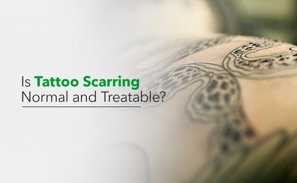 Is Tattoo Scarring Normal and Treatable?