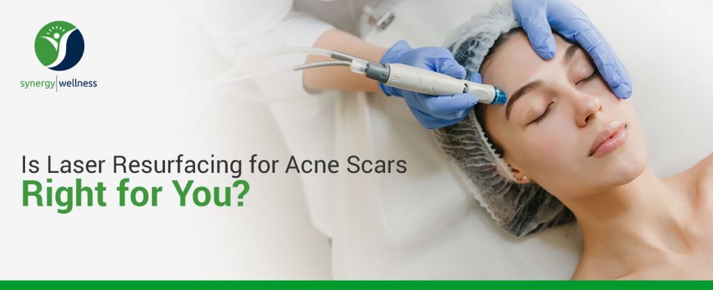 Is Laser Resurfacing for Acne Scars Right for You?