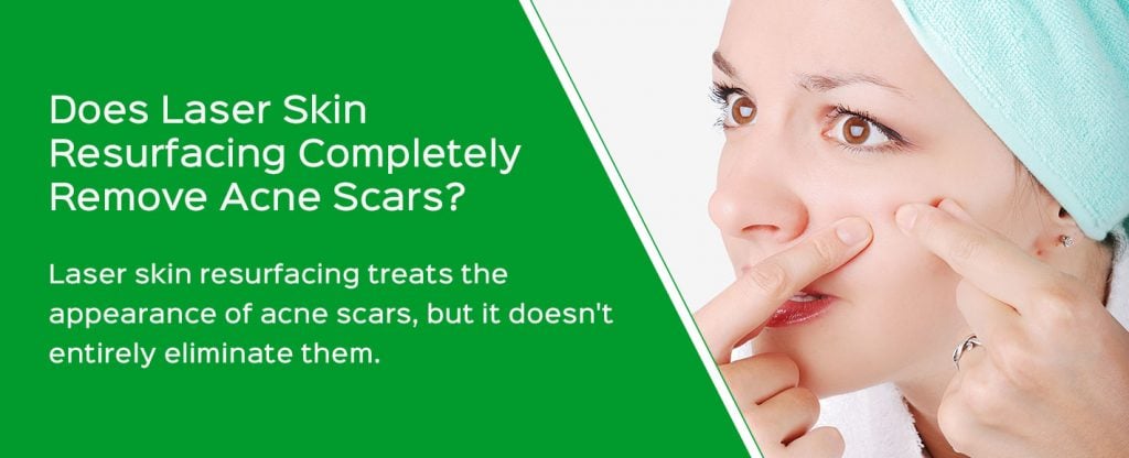 Does Laser Skin Resurfacing Completely Remove Acne Scars?