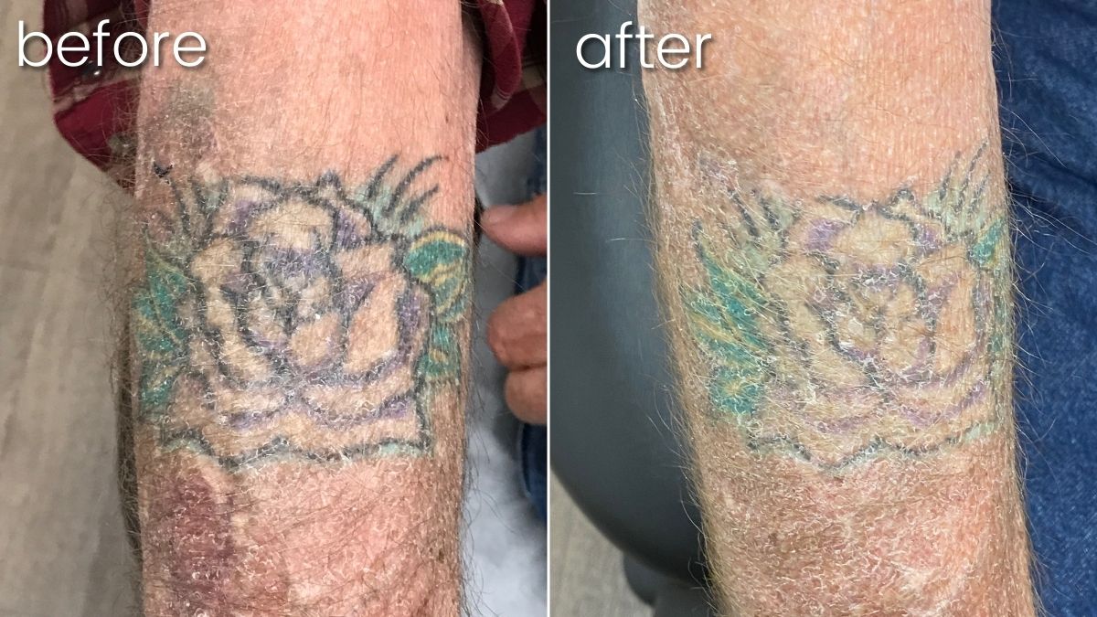 Before & After Laser Tattoo Removal on Man's Arm | Laser Tattoo Removal - Bakersfield CA