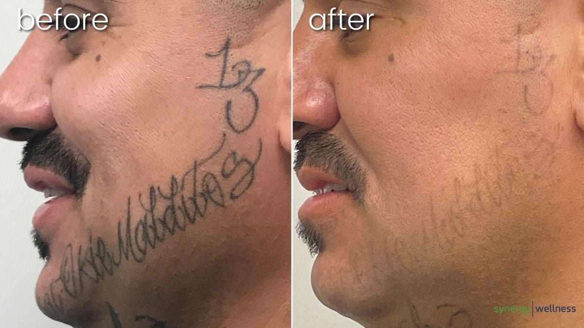 Before After Tattoo Removal on Man's Face | Tattoo Removal - Bakersfield CA