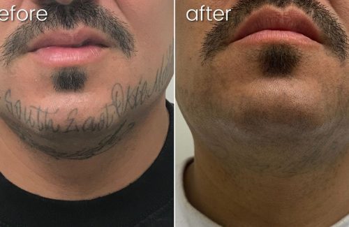 Before & After Laser Tattoo Removal on Man's Face | Bakersfield CA
