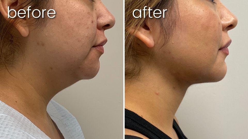 before and after neck