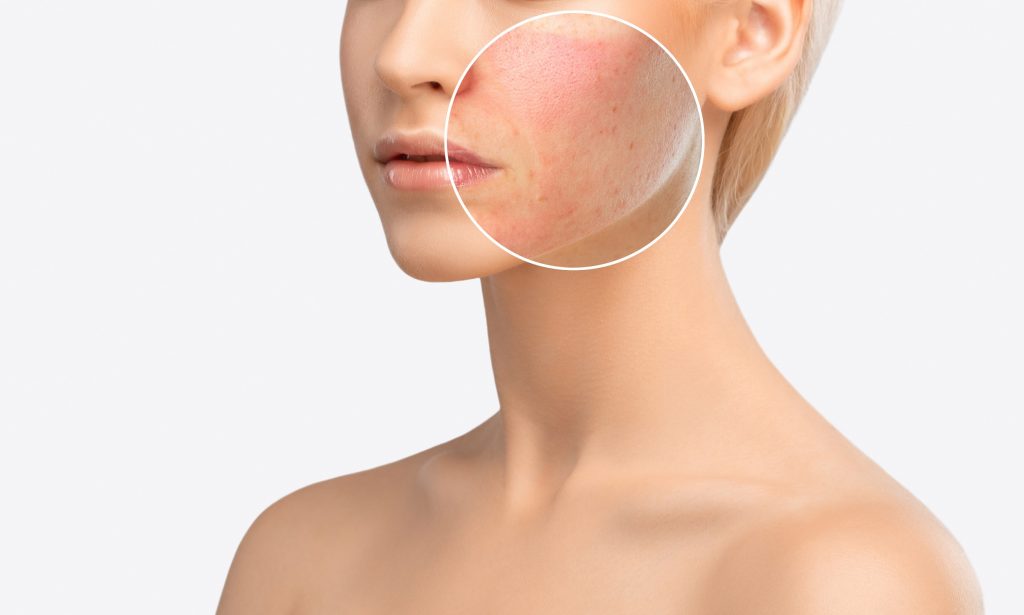 Acne Face Mapping