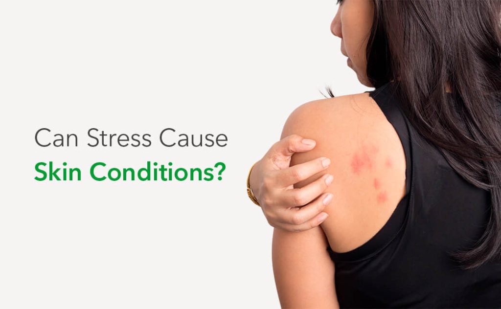 Can Stress Cause Skin Conditions?