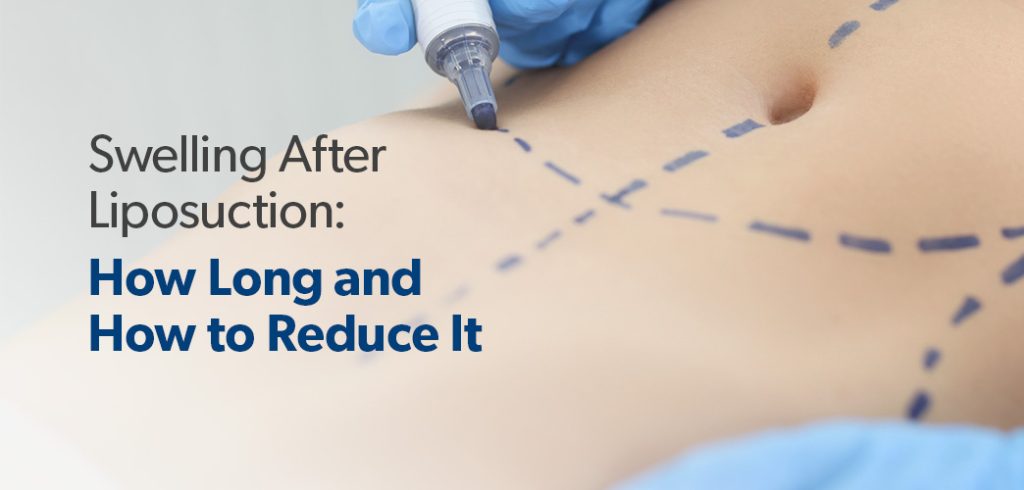 Swelling After Liposuction: How Long and How to Reduce It