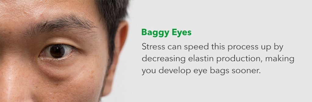 Baggy Eyes