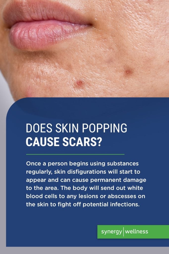 Does Skin Popping Cause Scars?