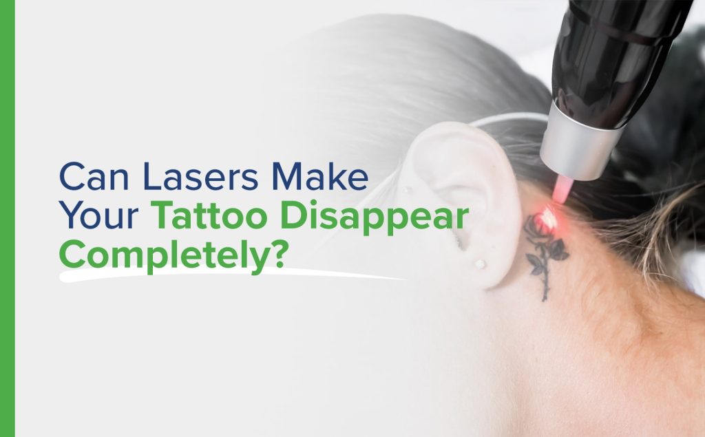 Can Lasers Make Your Tattoo Disappear Completely?
