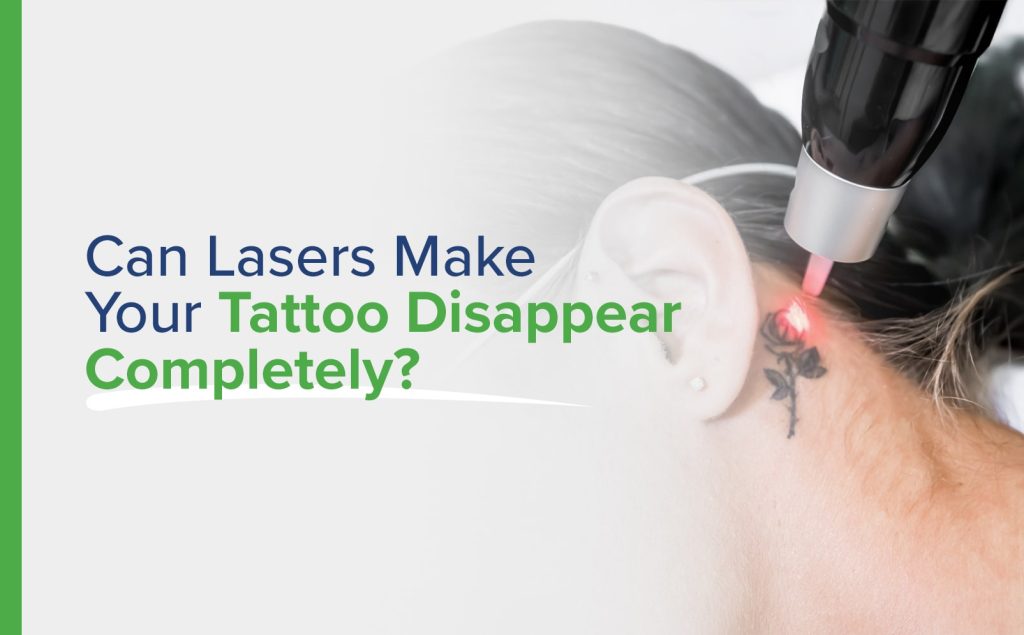 Tattoo Removal With The Help Of Q Switch ND Yag Laser  By Dr Malay Mehta   Lybrate