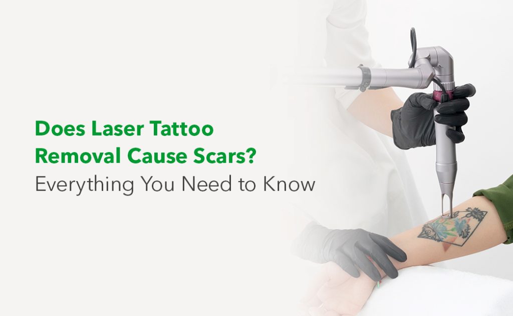 Does Laser Tattoo Removal Cause Scars? Everything You Need to Know -  Synergy Wellness